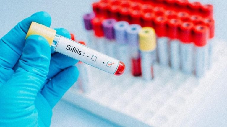 Sifilis