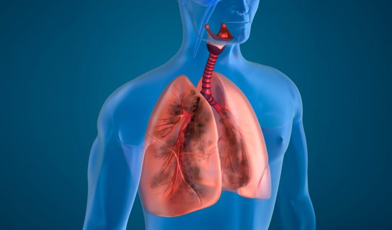 Enfermedad-pulmonar-obstructiva