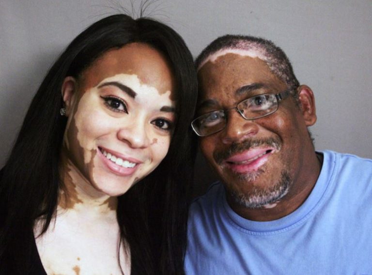 Vitiligo Foto mymodernmet.com