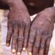 ARCHIVO - Imagen de 1997 facilitada por los Centros para el Control y la Prevención de Enfermedades de Estados Unidos (CDC, por sus siglas en inglés) durante una investigación sobre un brote de viruela símica, que tuvo lugar en República Democrática del Congo.
