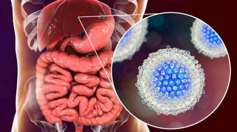 Hepatitis